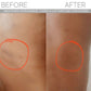 SCULPT Cellulite Cupping Set