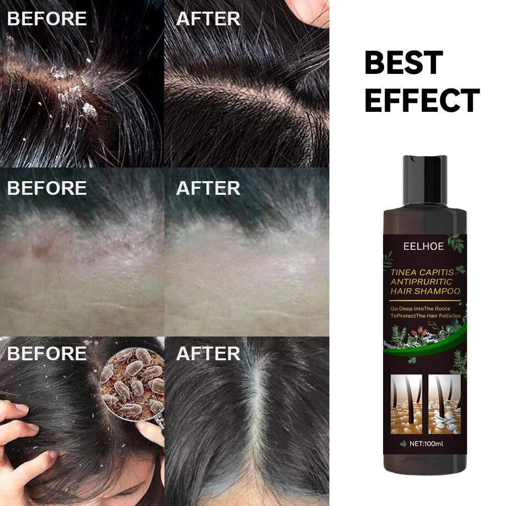 EELHOE Champú Anticaspa - Alivio de la picazón, Prevención de la caída del cabello, Control de la grasa y Cuidado refrescante