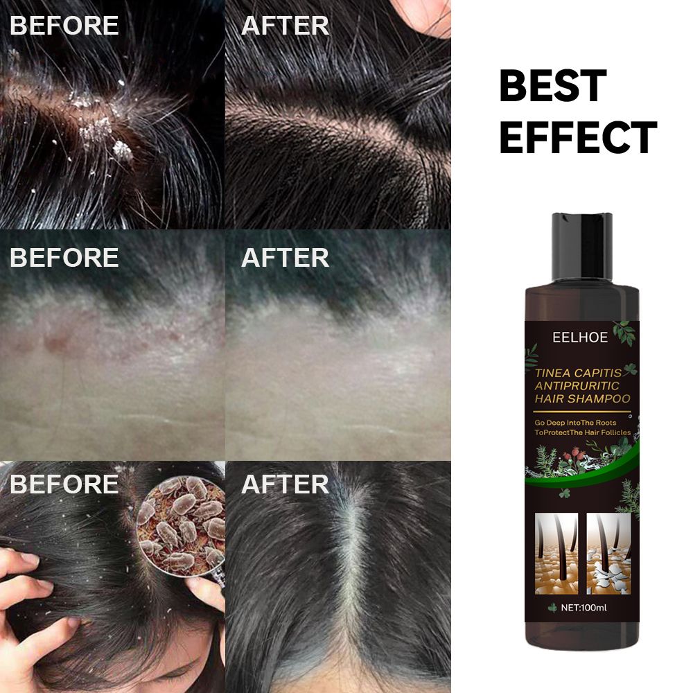 Champú anticaspa, Champú para cuero cabelludo propenso a foliculitis, dermatitis, caspa, picazón y descamación, Trata la caspa y la dermatitis seborreica, Champú antipicazón